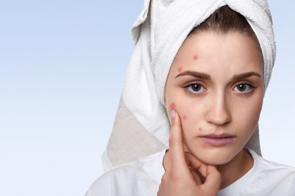 How To Remove Pimples Naturally At Home